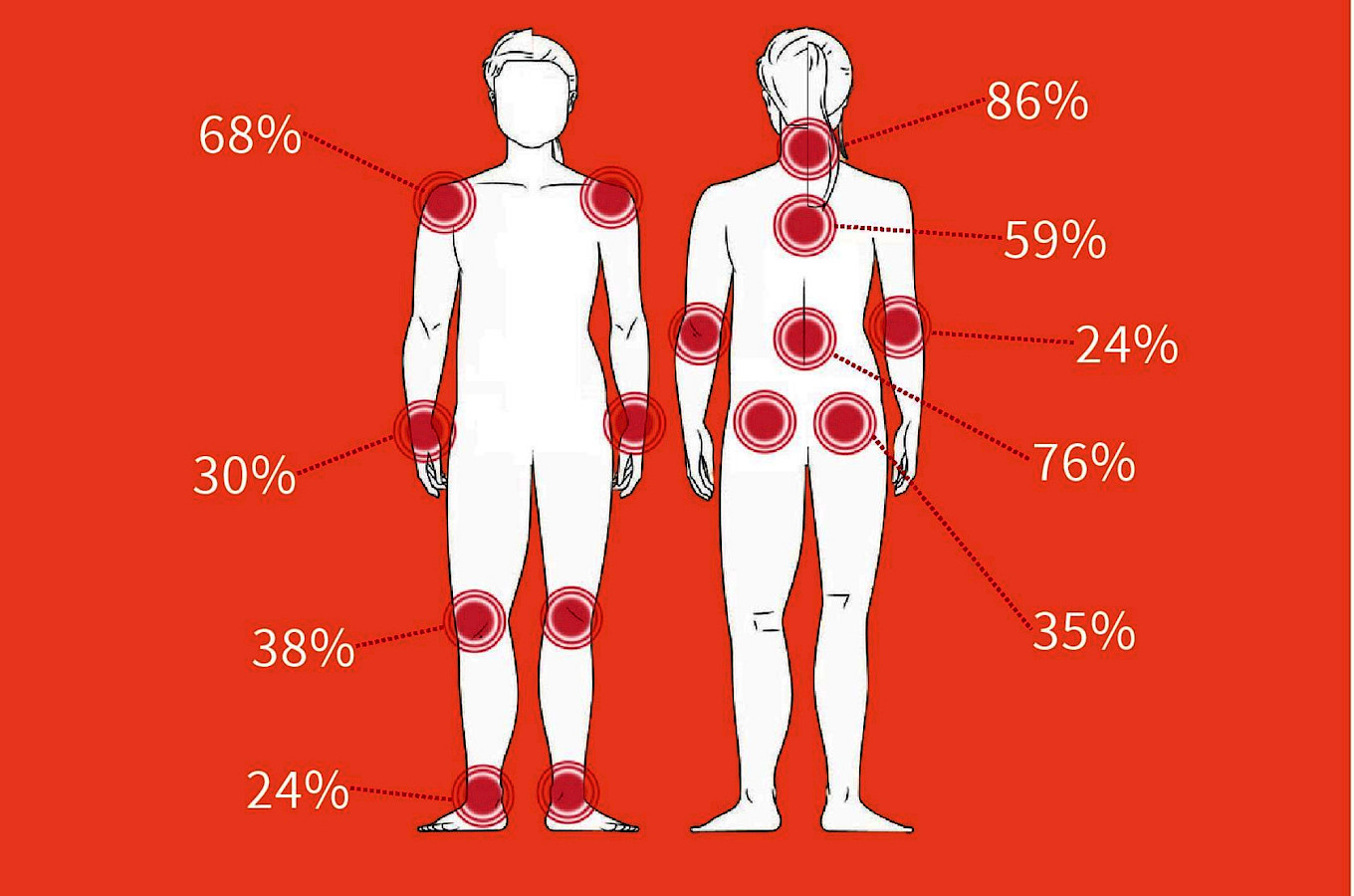 Distribuzione dei DMS per posizione del corpo, % basate su 419 risposte. Cifre di Unisanté.